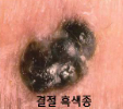  흑색종 증상/피부암/치료법