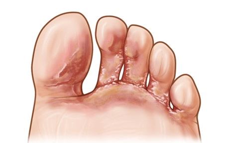 수포형 발무좀 (Vesicular type) 