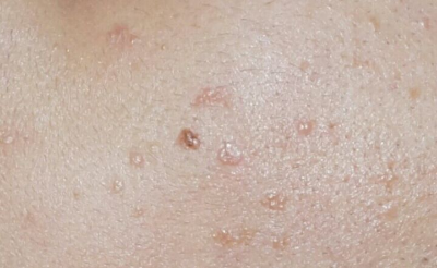  편평 사마귀 없애는 방법과 흉터 치료
