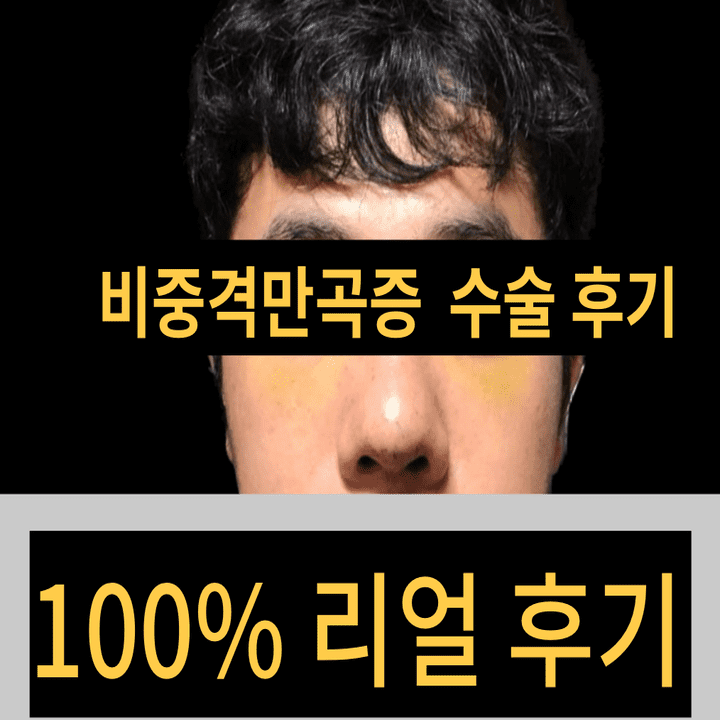  비중격만곡증 성형외과 수술후기(부작용)긴글주의 1화