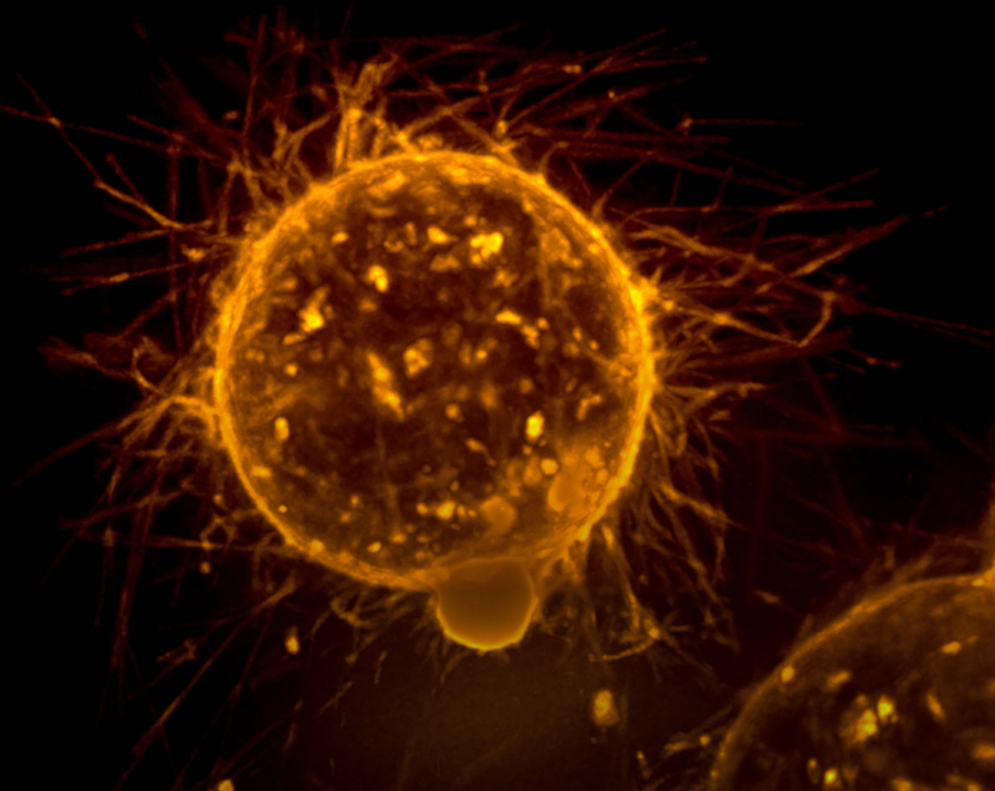 인체에서 자라고 있는 암세포를 마이크로 현미경으로 크게 확대를 하여 찍은 사진