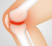 무릎통증 5가지 원인