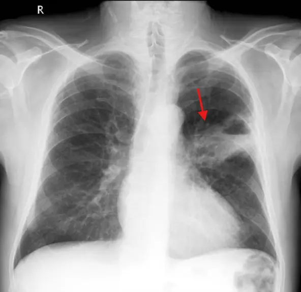 lung squamous cell carcinoma