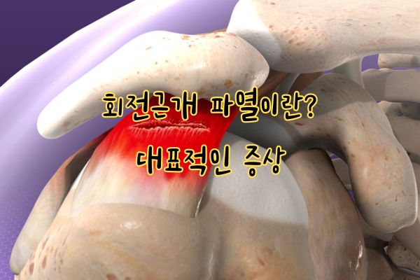 회전근개 파열이란? 대표적인 증상