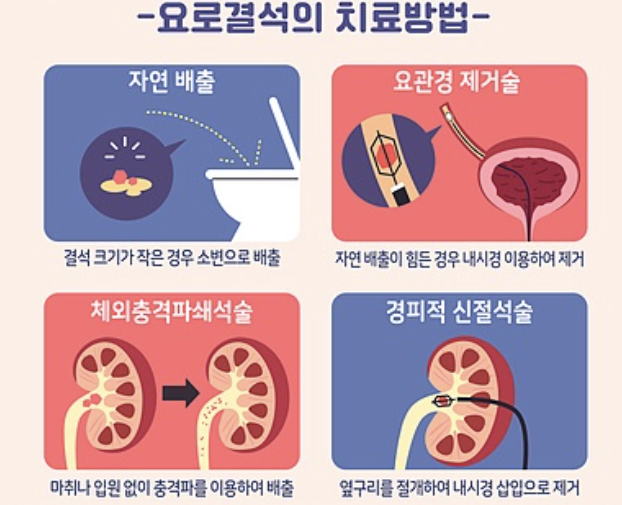 왼쪽 옆구리 통증 의심되는병 5