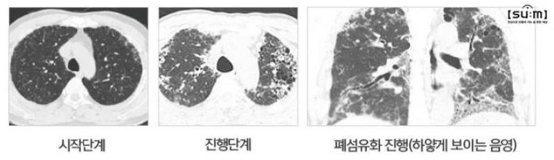 폐섬유증 진행 단계