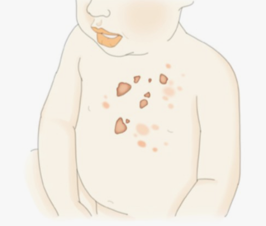 농가진에 걸려서 상체에 수포가 생겨있는 아기의 그림