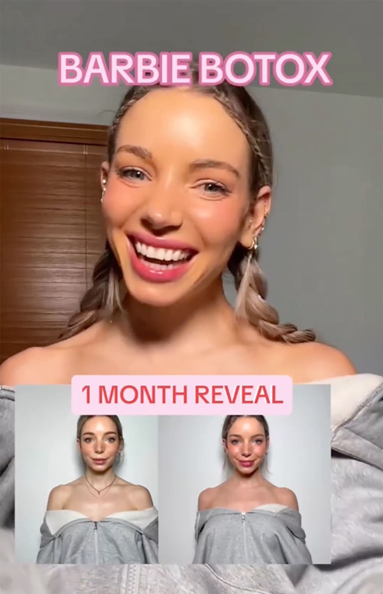 요즘 유행하는 &#39;바비 보톡스&#39;란 VIDEO: What is ‘Barbie Botox&#44;’ TikTok’s latest beauty obsession?