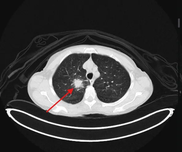 lung adenocarcinoma chest CT