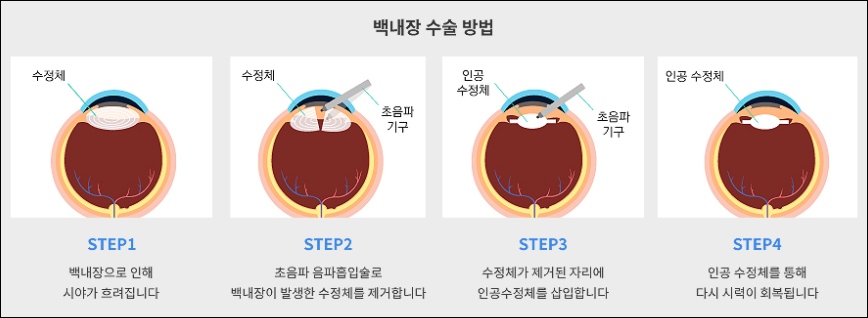 백내장수술 비용 가격 견적 실비보험 적용여부