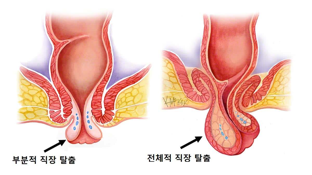 직장 통증 치료 방법