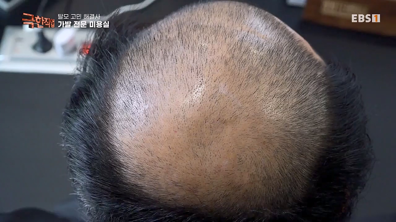 TV - 전 국민의 평생학교 EBS탈모 고민 해결사.mp4_20230508_195802.042.jpg