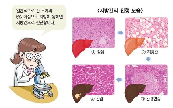 지방간