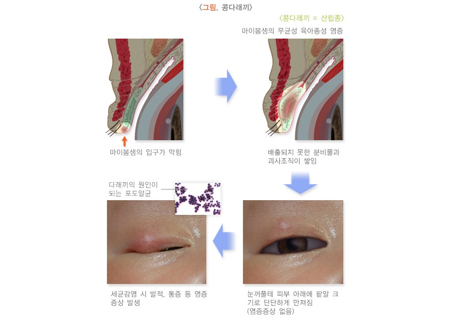 콩다래끼-발생-과정