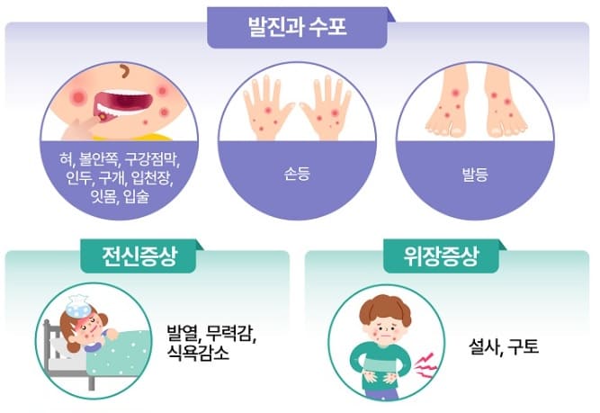 수족구병-증상