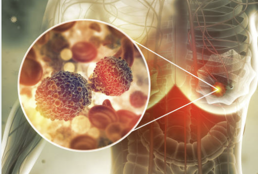 유방암 2기 생존율
