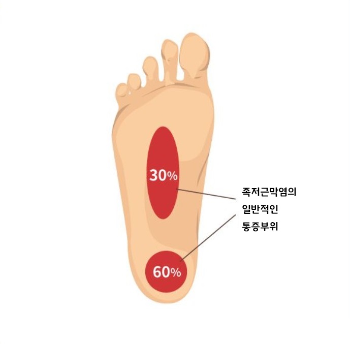 족저근막염 통증 부위