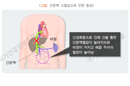 간문맥 고혈압으로인한 증상