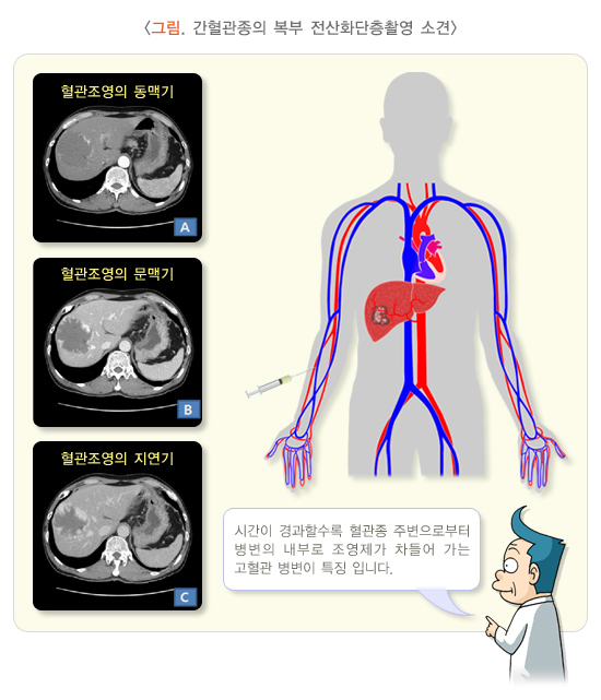  간혈관종