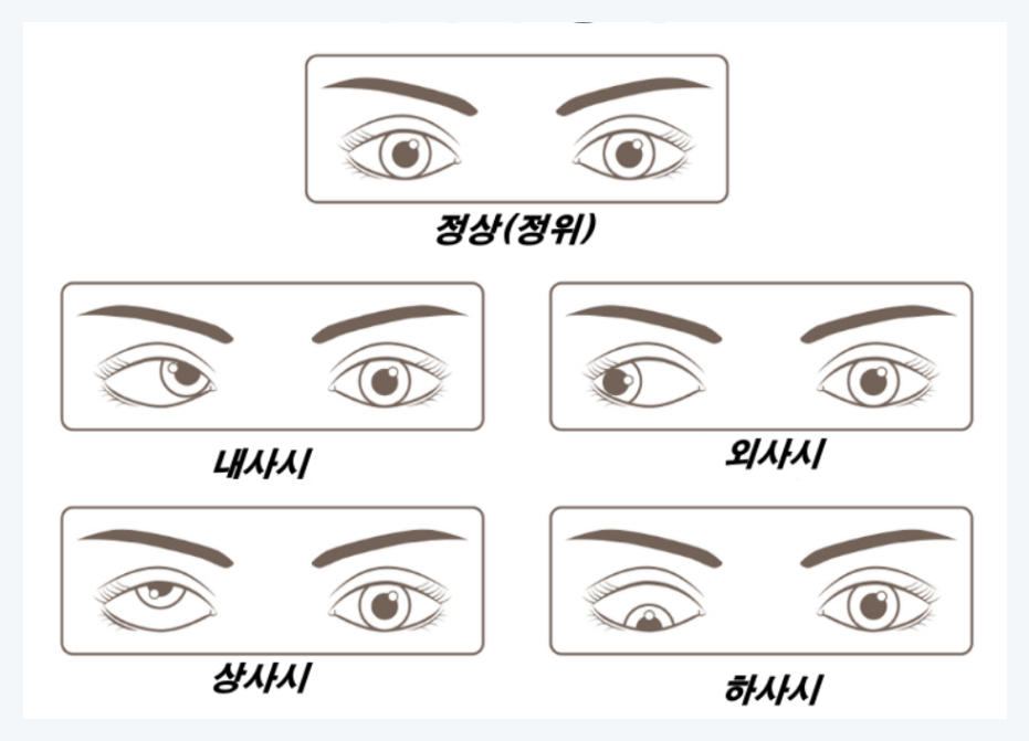 사시