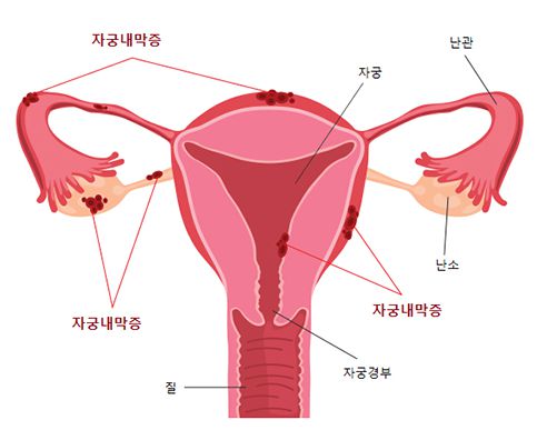 하혈의 원인- 자궁내막증