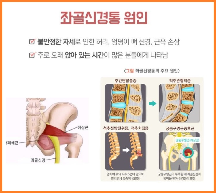 좌골신경통 원인