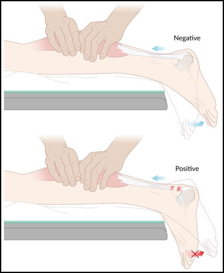 아킬레스건 파열을 테스트 하는 방법으로 엎드려서 종아리를 손으로 쥐었을 때의 반응을 보는 그림