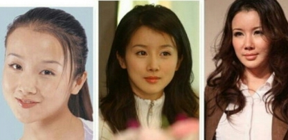 성형외과 고르는법과 주의사항 꿀팁 성형 가격 발품 후기 모음 : 네이버 블로그 성형외과 고르는법과 주의사항 꿀팁 성형 가격 발품 후기 모음 : 네이버 블로그