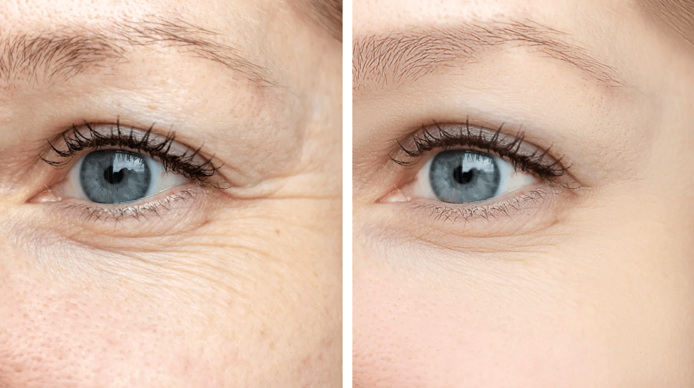 wrinkles under the eyes