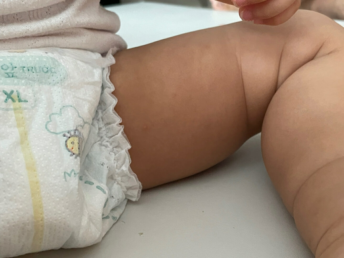  아기 수족구 증상 4일차