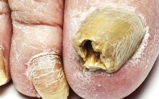  무좀 증상 및 치료 방법, 합병증, 예방 방법, 전염성 알아봤습니다.