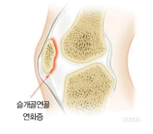 슬개골-연화증