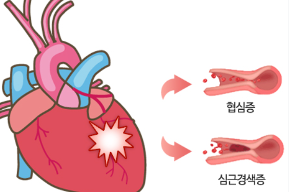 죽상경화증의 합병증