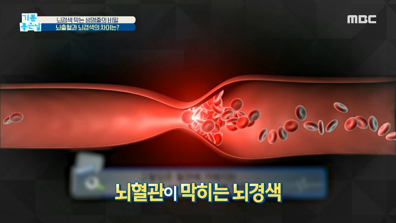  기분 좋은 날 뇌혈관 /뇌경색 /뇌출혈 원인 증상 치료 예방 혈관 건강 혈관 나이 뇌경색 테스트 자가진단법 쥐난 혈관 대마종자유 효능 효과