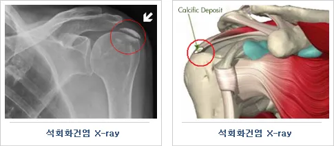 어깨 석회질치료방법