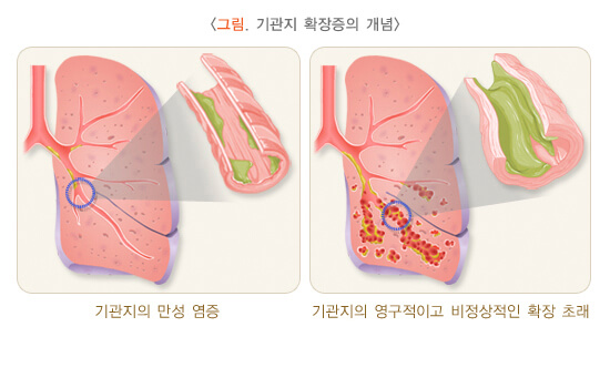 기관지 확장증에 대해 알아보기