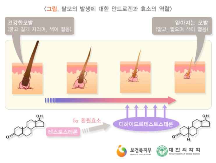 남성형탈모증