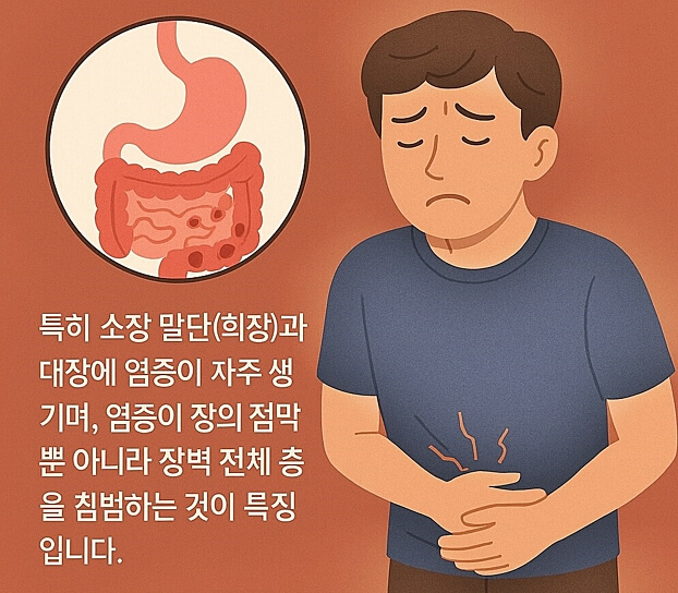 크론병