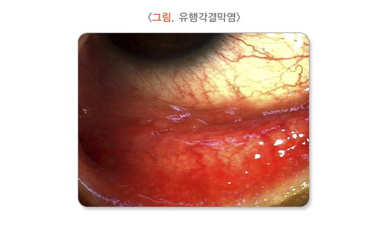  유행각결막염