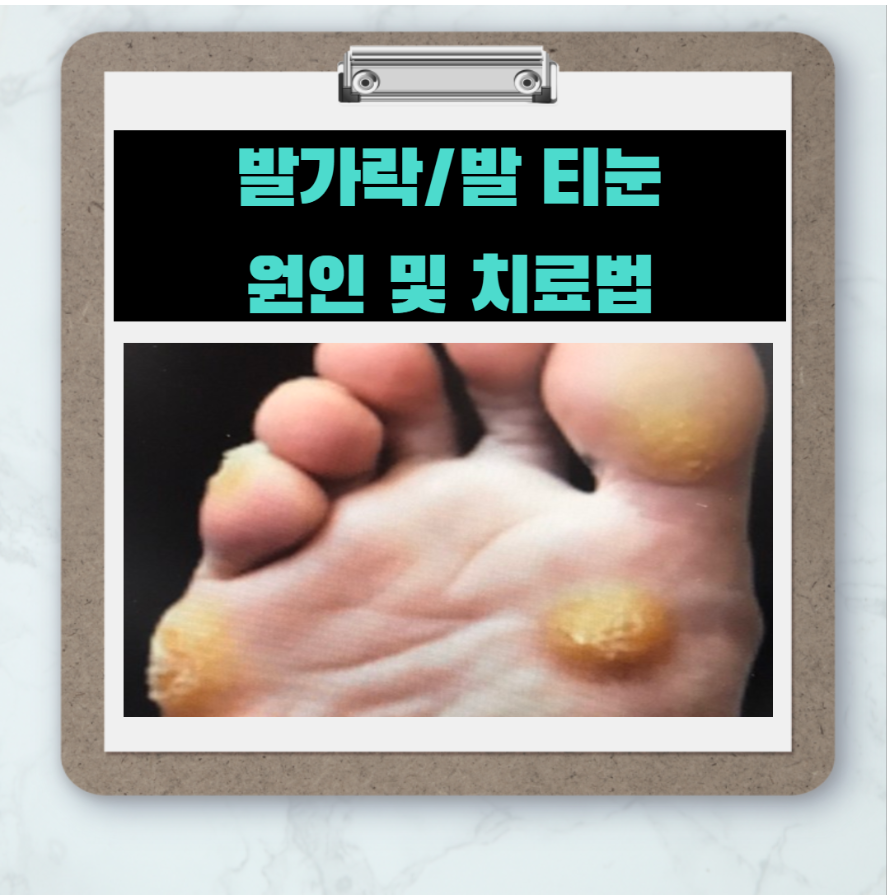  하이힐에 유발되는 발가락 티눈 원인 및 치료법