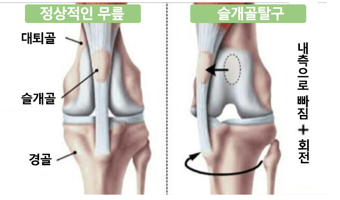 슬개골-탈구-수술-비용-자연치유