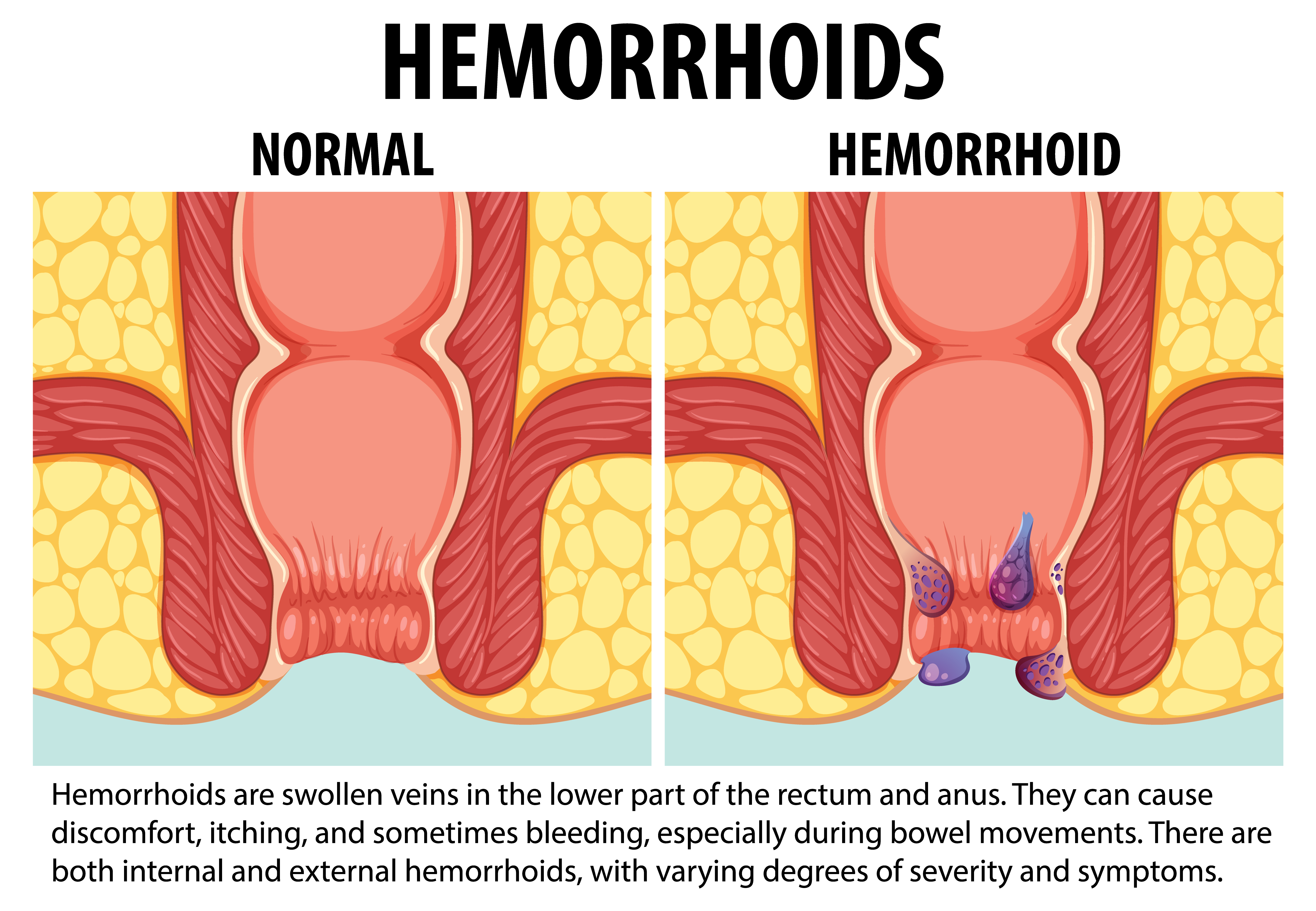 comparing-normal-internal-hemorrhoid-educational-infographic
