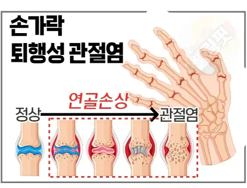 손가락-퇴행성-관절염