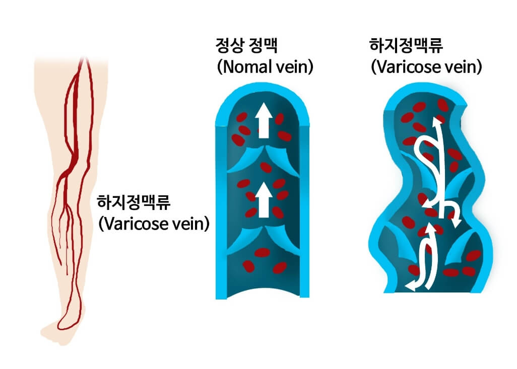 하지 정맥류