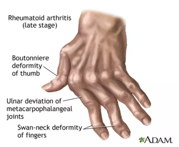 류마티스 관절염(Rheumatoid Arthritis)