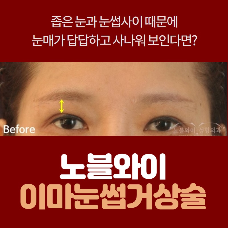  내시경이마거상술후기 두꺼워진 쌍꺼풀