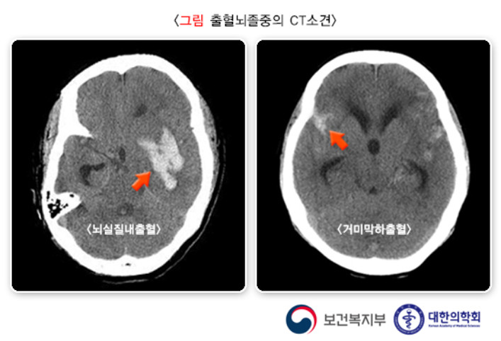 뇌졸중초기전조증상