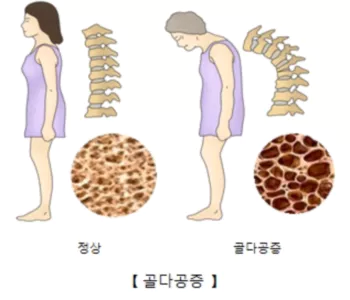 골다공증-예방2