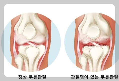 관절염