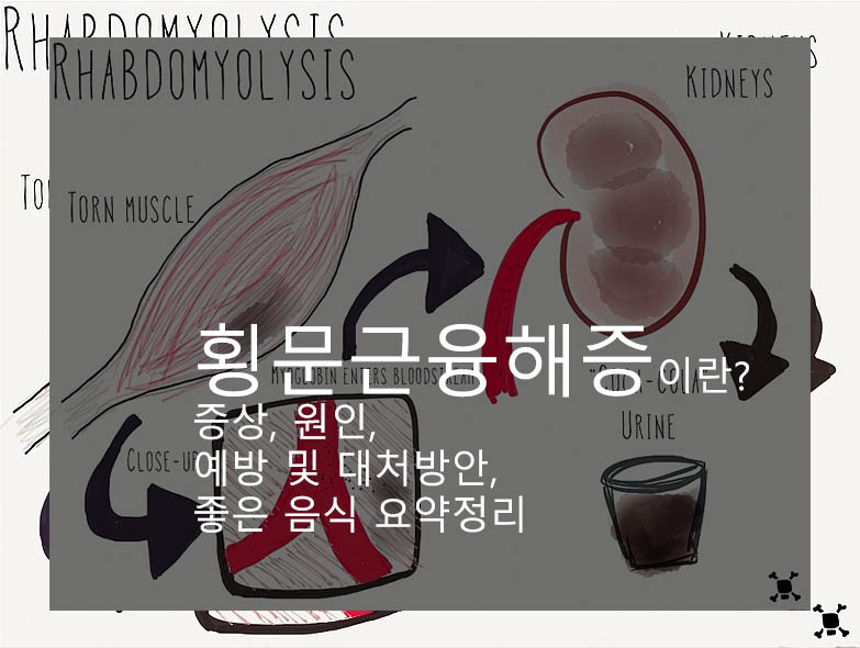 횡문근융해증이란? 증상, 원인, 예방 및 대처방안, 좋은 음식 요약정리